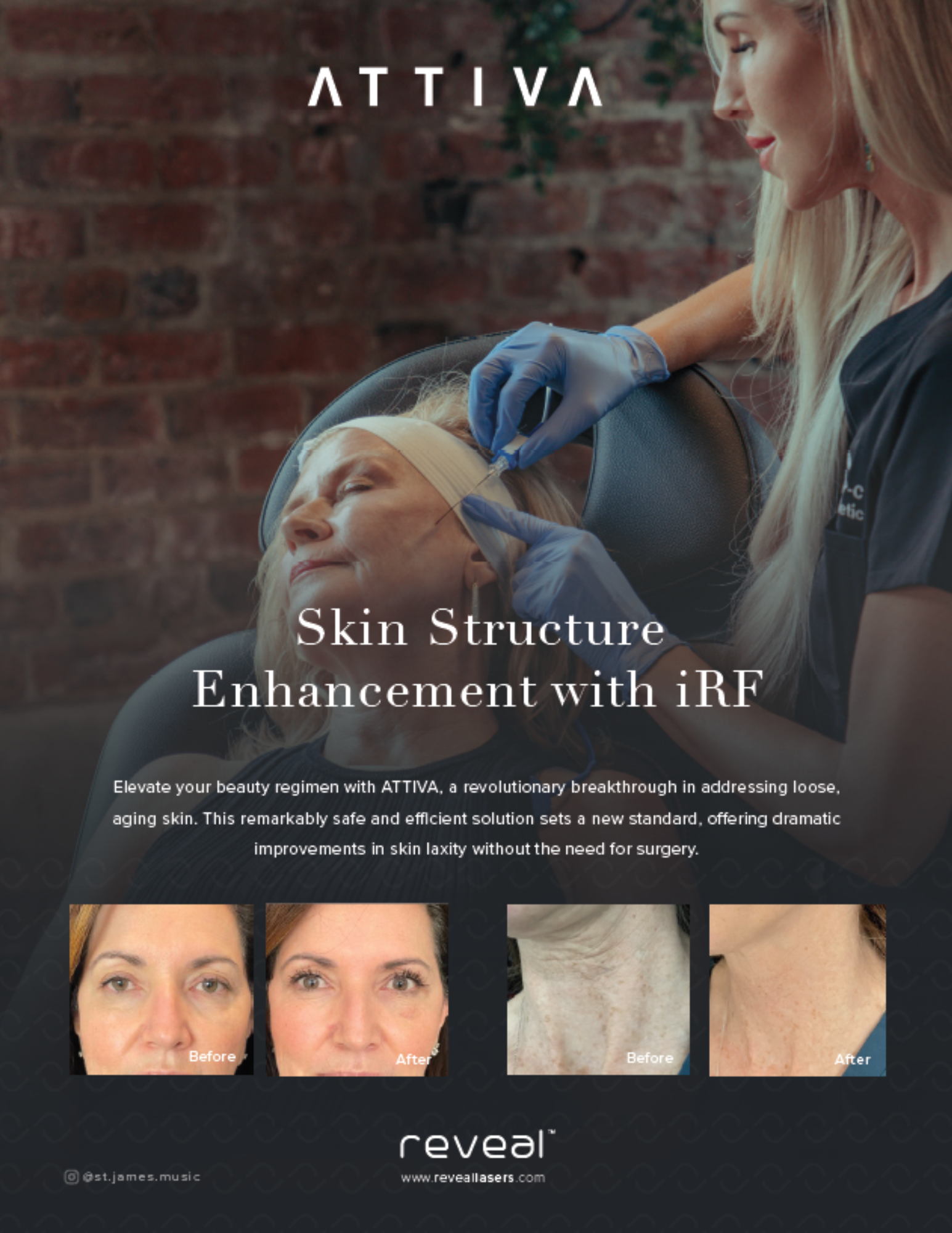 Skin Structure Enhancement with iRF Flyer