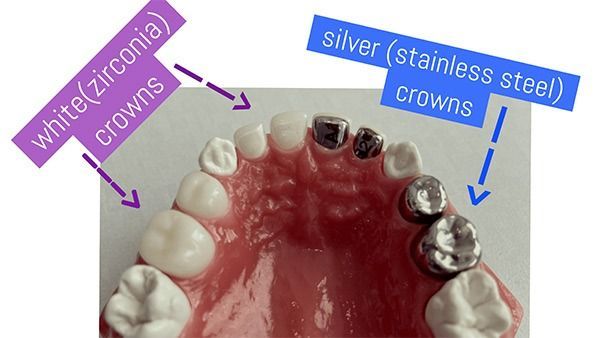 Model of teeth showing white zirconia crowns and silver stainless steel crowns.
