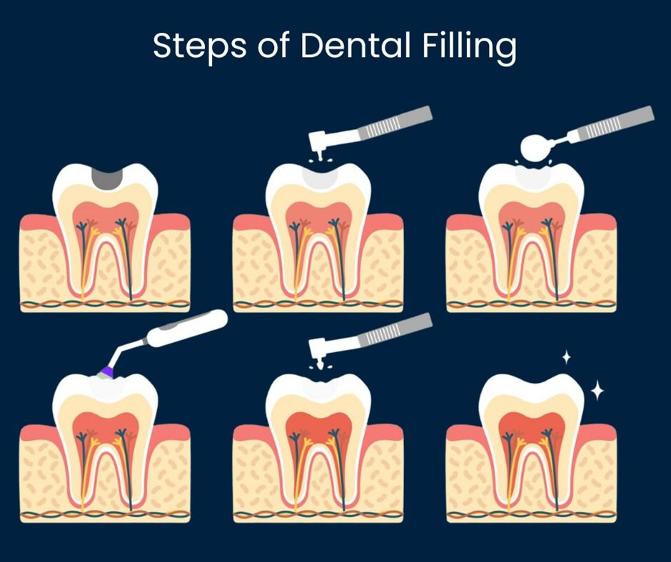 Diagram showing the steps of a dental filling. It depicts a tooth being drilled, cleaned, filled, and polished, with various tools used.