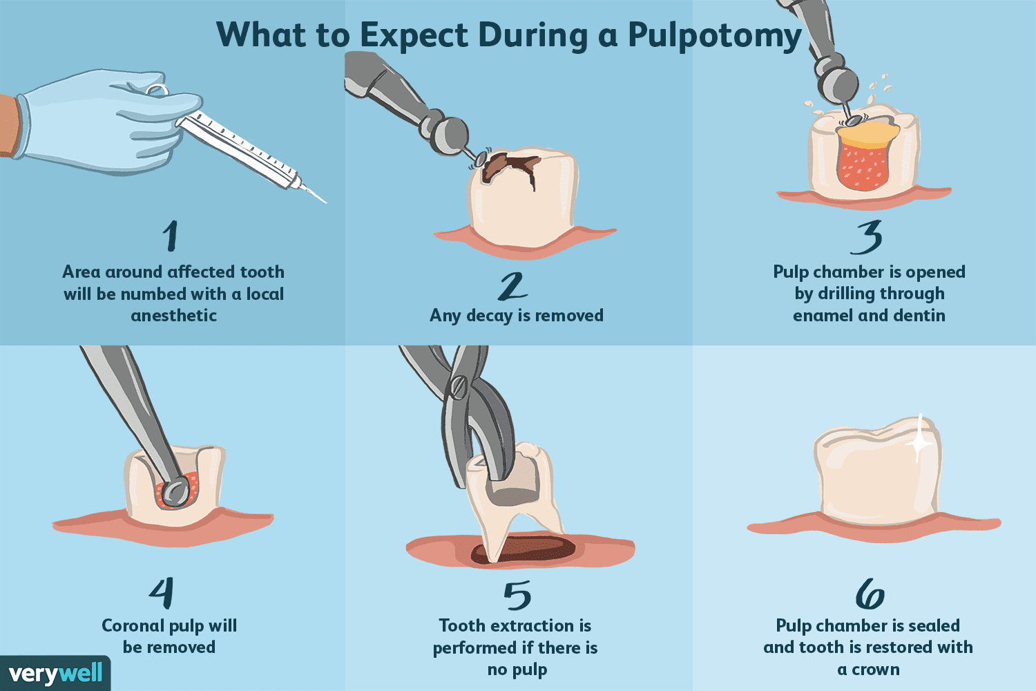 Illustration of a pulpotomy procedure: steps shown include anesthesia, removing decay, opening pulp chamber, removing pulp, and sealing the tooth.