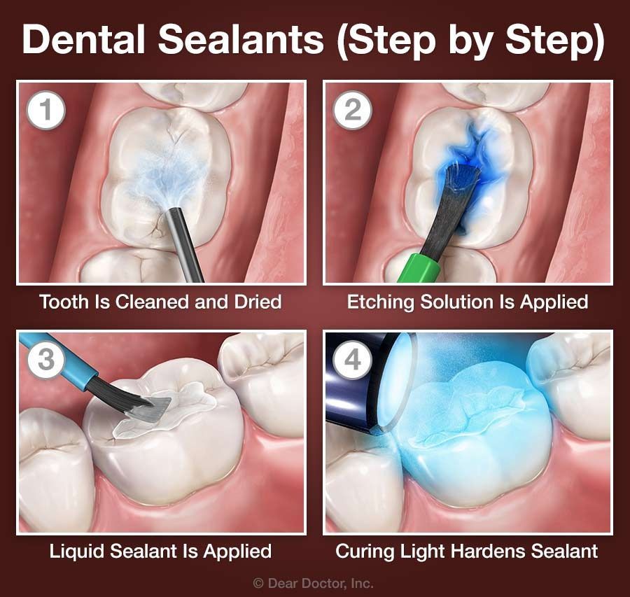 Diagram of the dental sealant process: Tooth cleaned, etching solution applied, liquid sealant added, and cured with light.