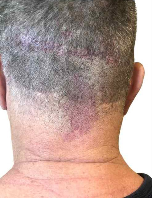 Scalp micropigmentation