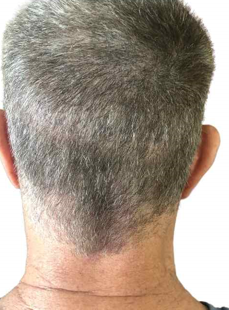 Scalp micropigmentation