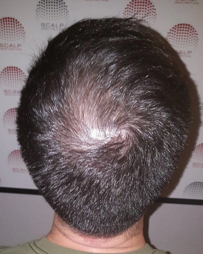 Scalp micropigmentation #11