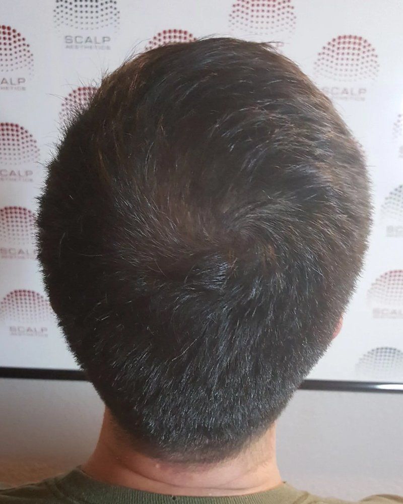 Scalp micropigmentation #12