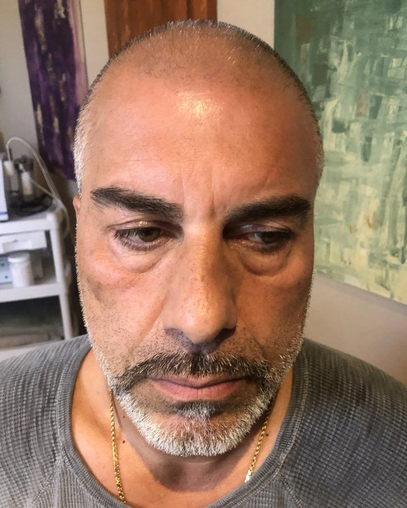 Scalp micropigmentation #13