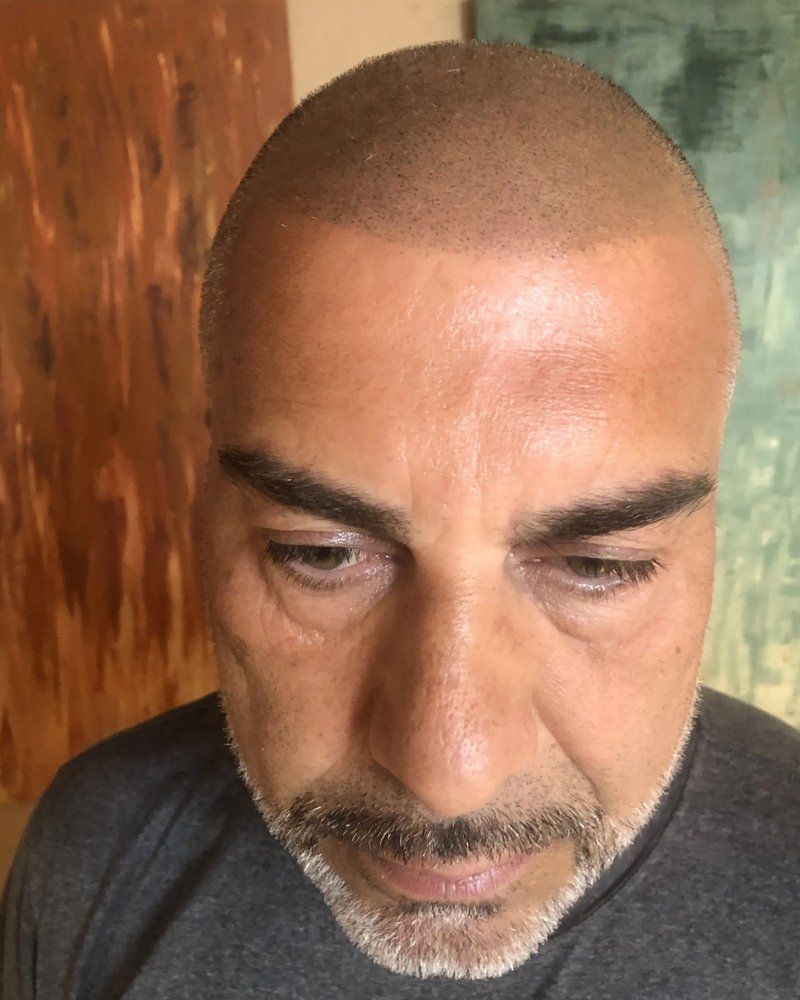 Scalp micropigmentation #14