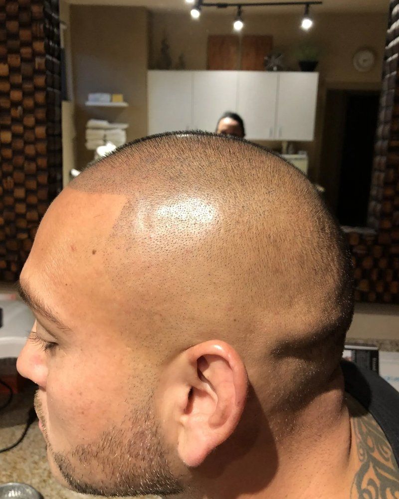 Scalp micropigmentation #15