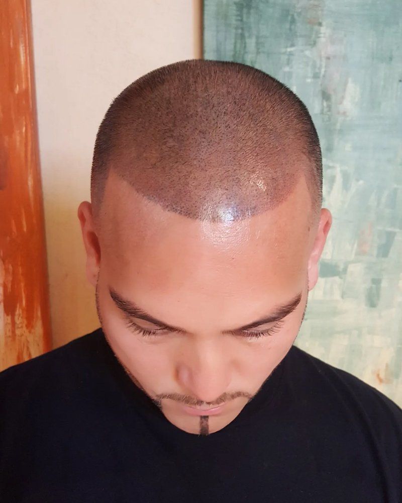 Scalp micropigmentation #17