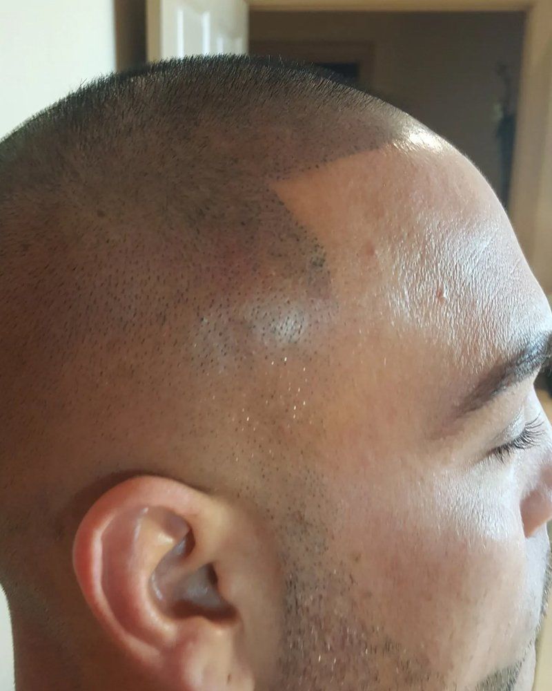 Scalp micropigmentation #18