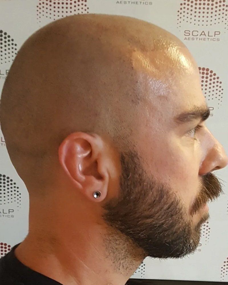 Scalp micropigmentation #20