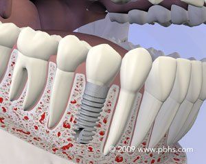 Dental Implants