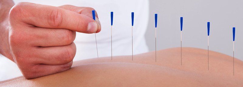 Acupuncture