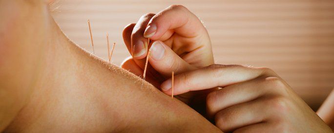 Acupuncture