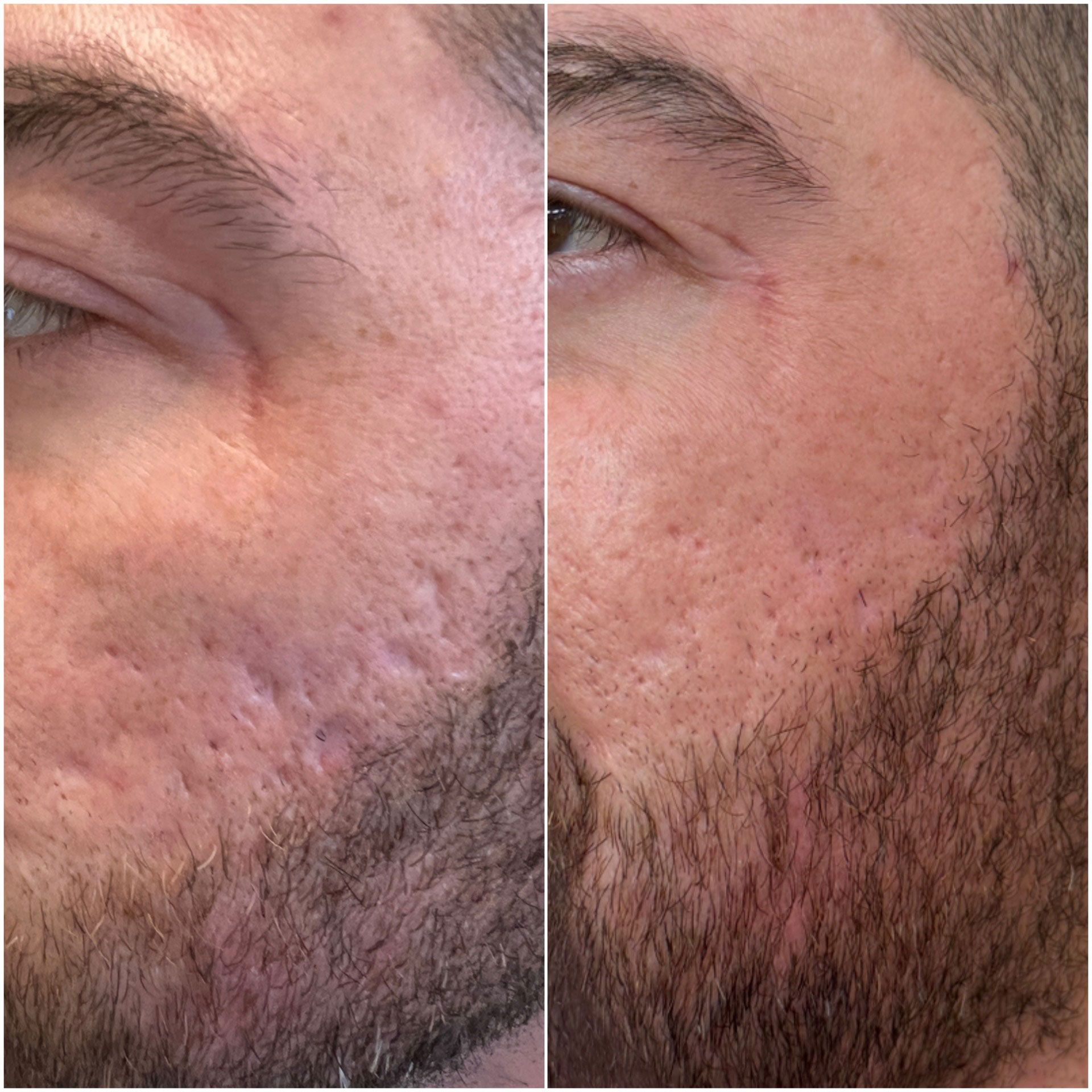 Comparison of a man's face before and after scar treatment; skin appears smoother and less scarred.