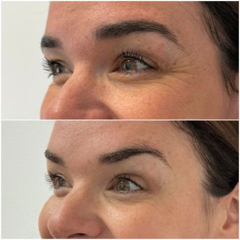 Before-and-after of a woman's eyes. Top: wrinkles. Bottom: smoother skin after treatment.