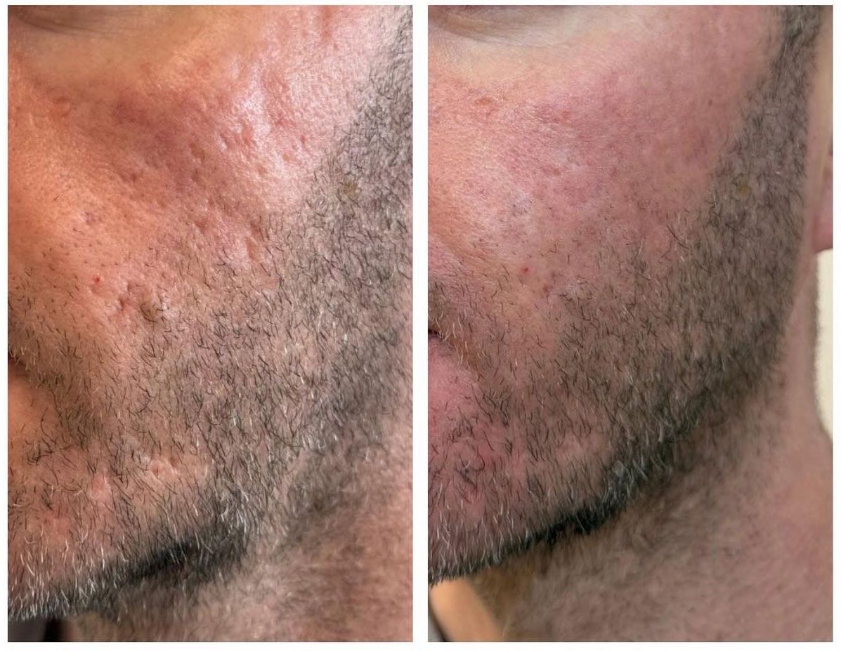Comparison of a man's face before and after acne scar treatment. The right side shows improvement.