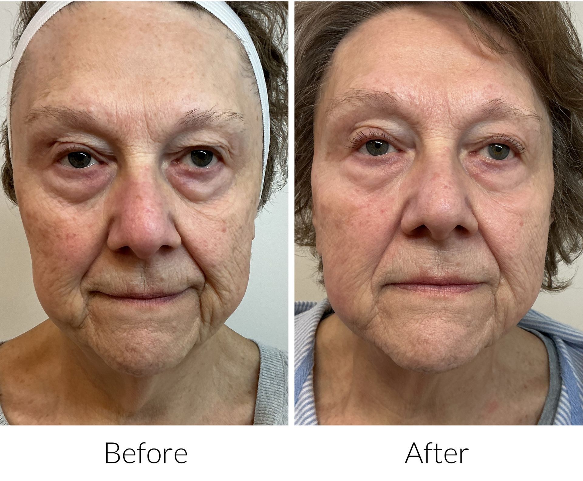 Side-by-side comparison of a torso, before and after hair removal; showing a hair-covered chest and abdomen, then smooth skin.