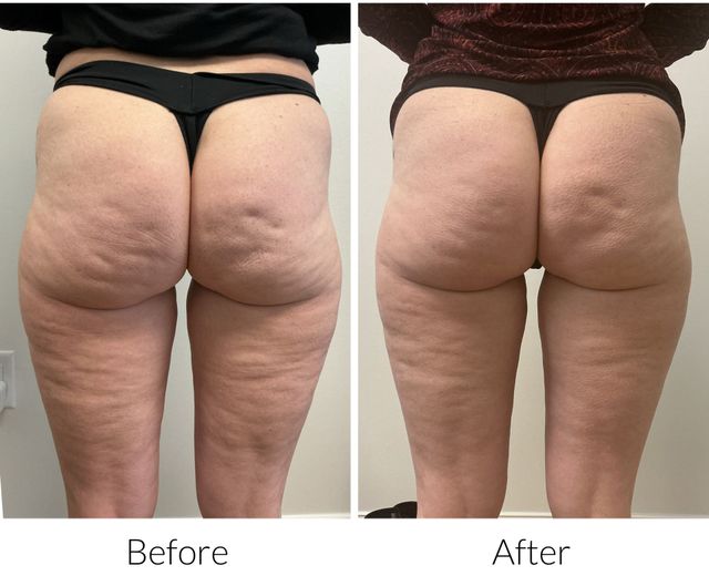 Side-by-side comparison of a person's face. Left side shows more redness. Right side shows reduced redness and improved skin texture.