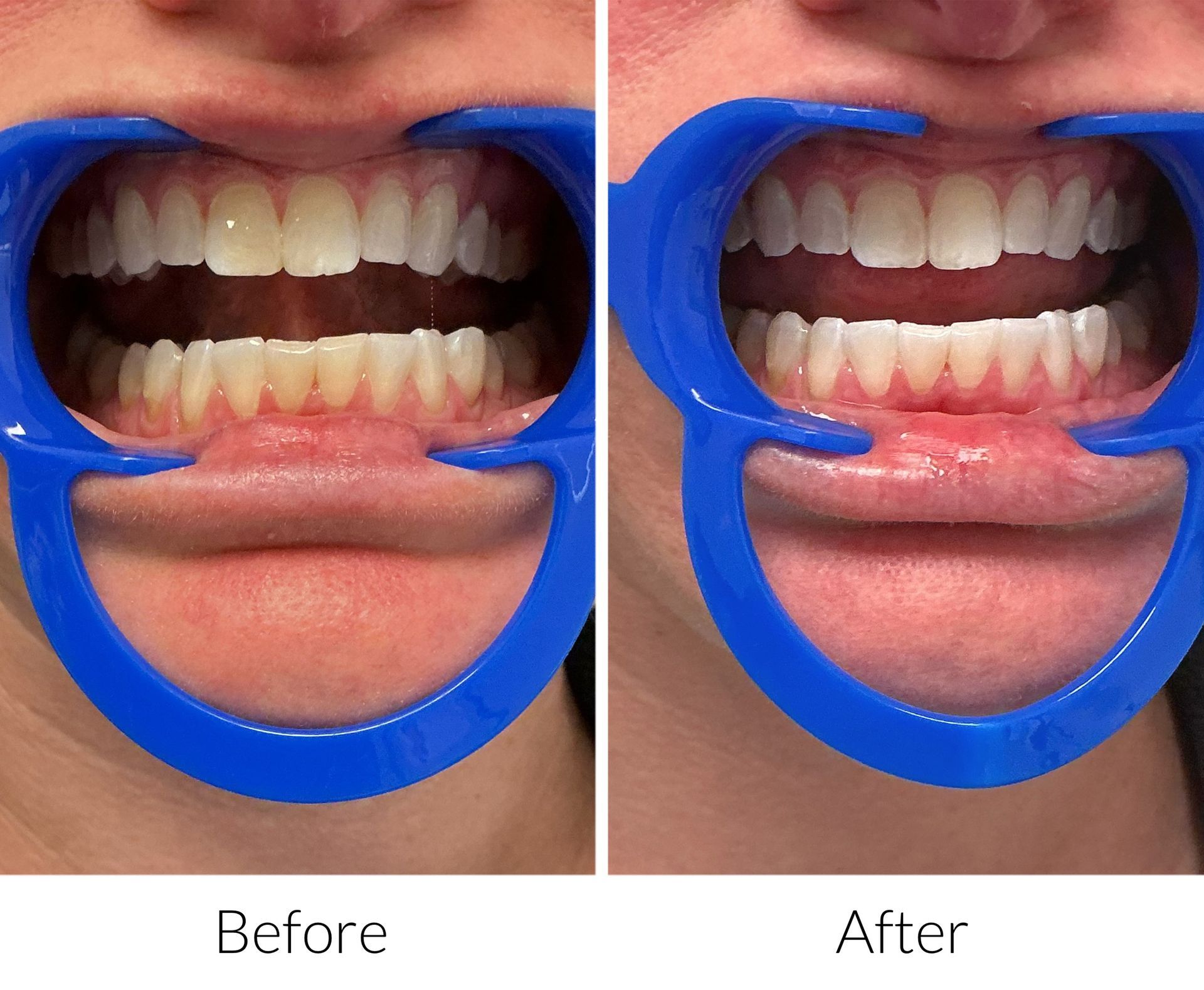 Before-and-after of a person's teeth, showing an opened mouth with a retractor, then a smiling mouth with brighter teeth.