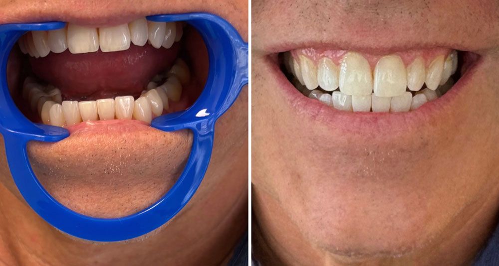 Before-and-after of a person's teeth, showing an opened mouth with a retractor, then a smiling mouth with brighter teeth.