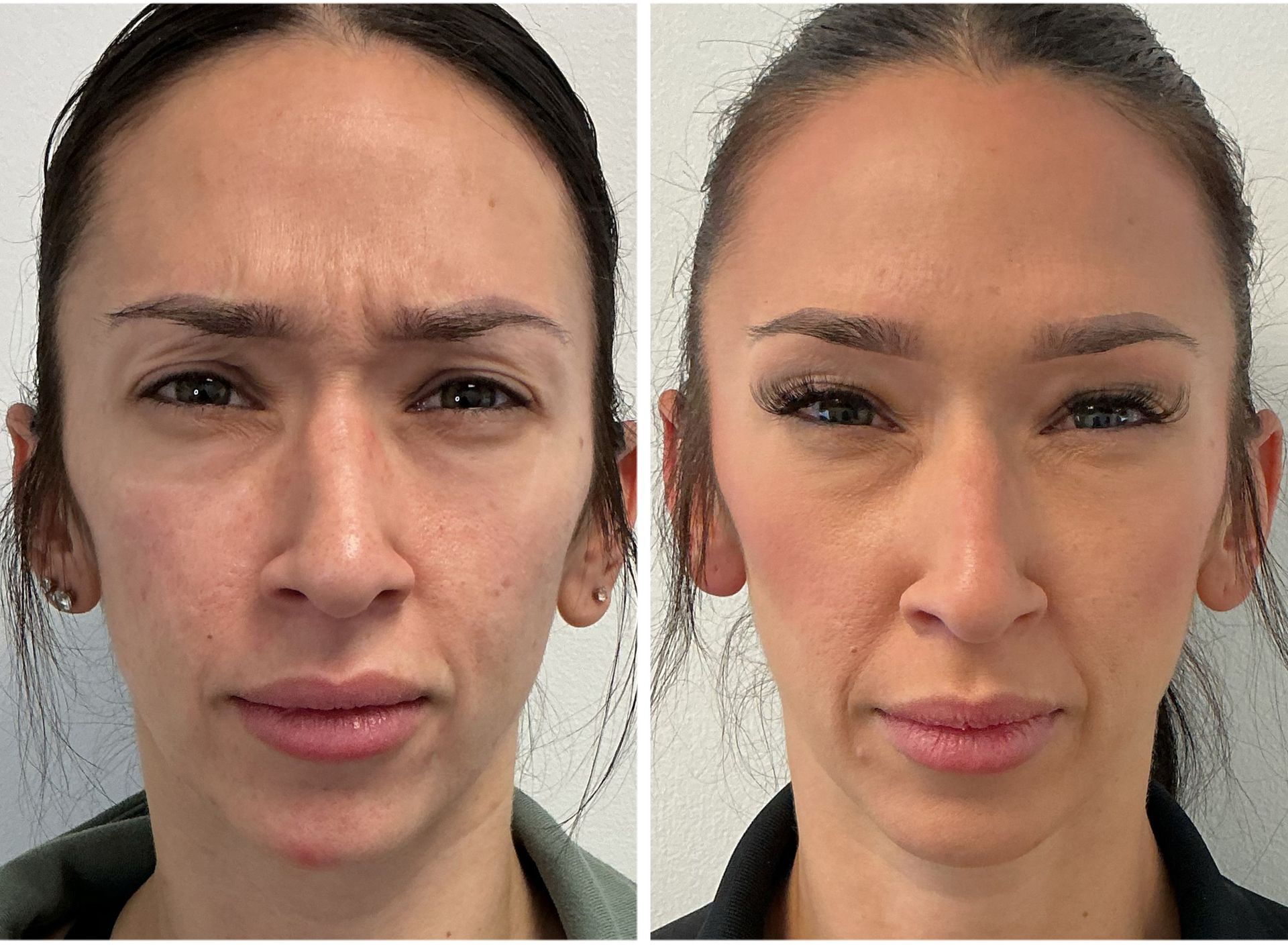 Side-by-side view of a face before and after treatment, reducing forehead wrinkles.