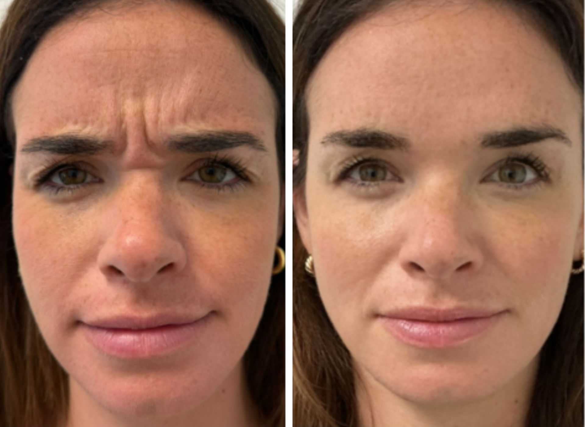 Before and after photos showing reduction of forehead wrinkles.