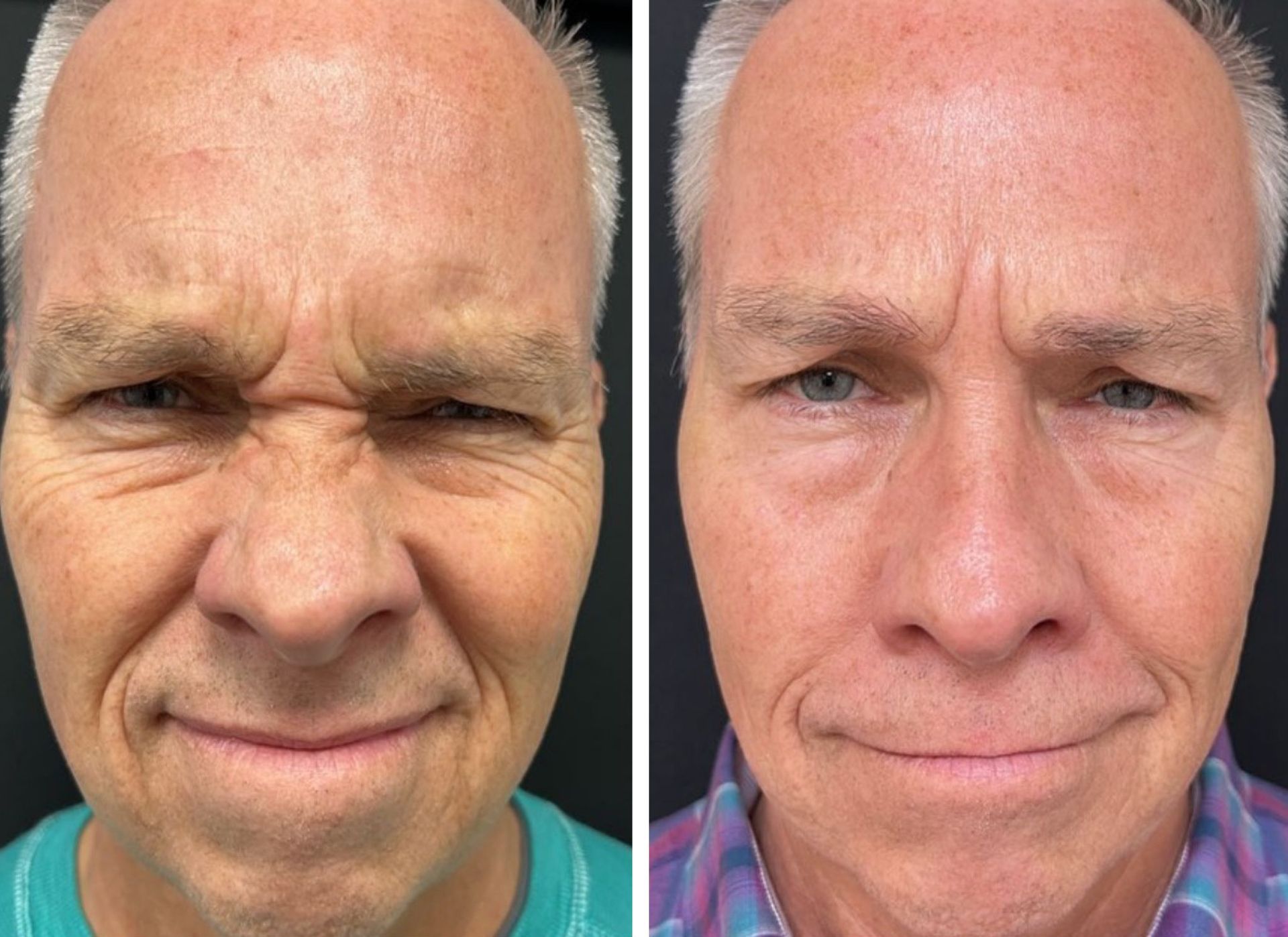 Before and after photos of a man's face. Left: wrinkled brow. Right: smoother forehead, less pronounced wrinkles.