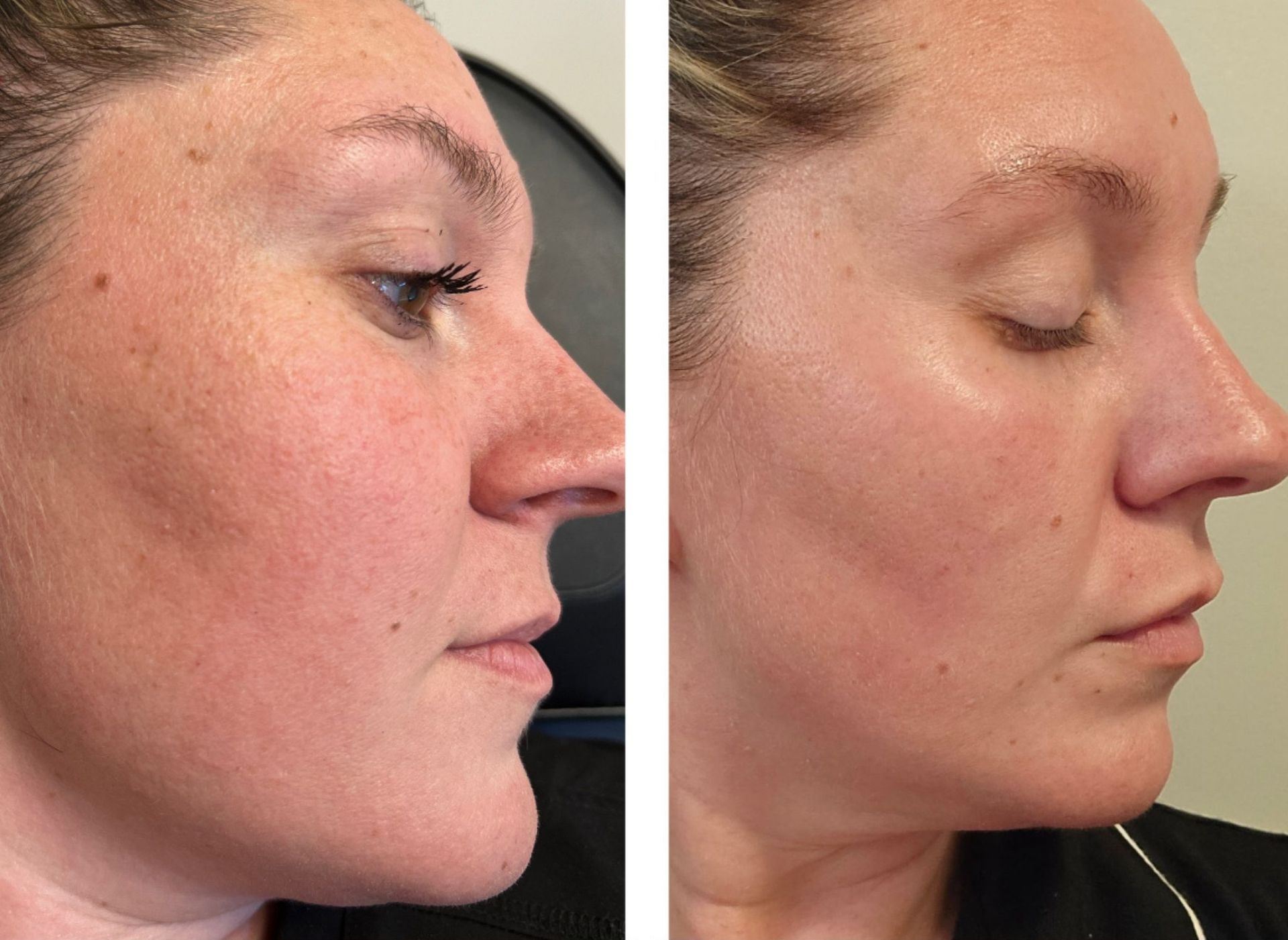 Two side-profile views of a person's face. The left shows redness and uneven skin. The right shows improved skin with a brighter appearance.