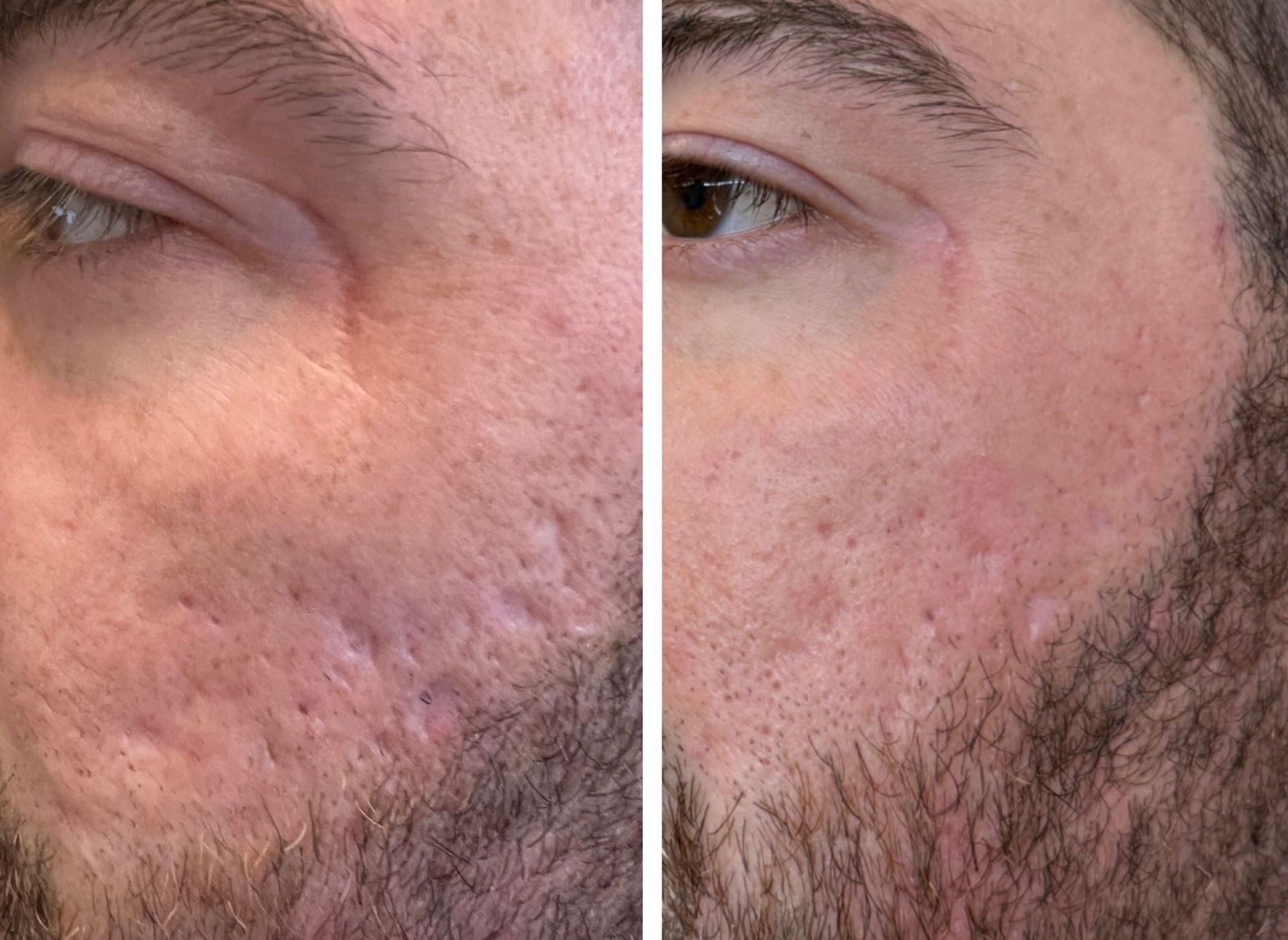 Before-and-after comparison of a person's facial skin. The left side shows acne scars, the right side shows improved skin.