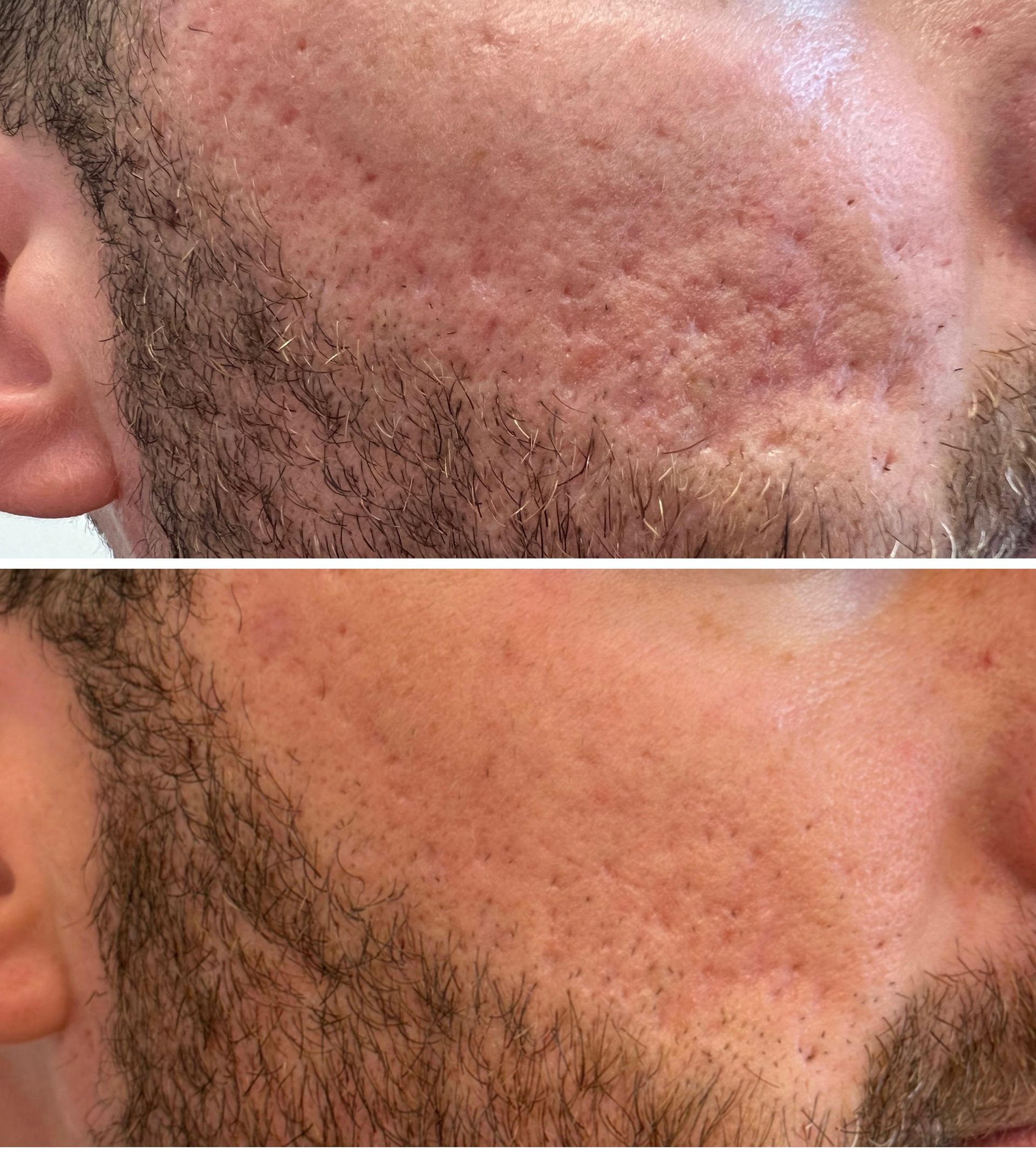 Before-and-after of facial scarring. Top photo: scarred skin. Bottom photo: improved skin texture.