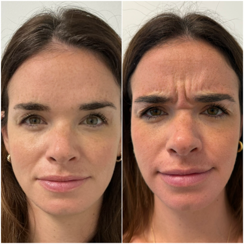 Before and after comparison of a woman's face, showing fewer forehead wrinkles after treatment.