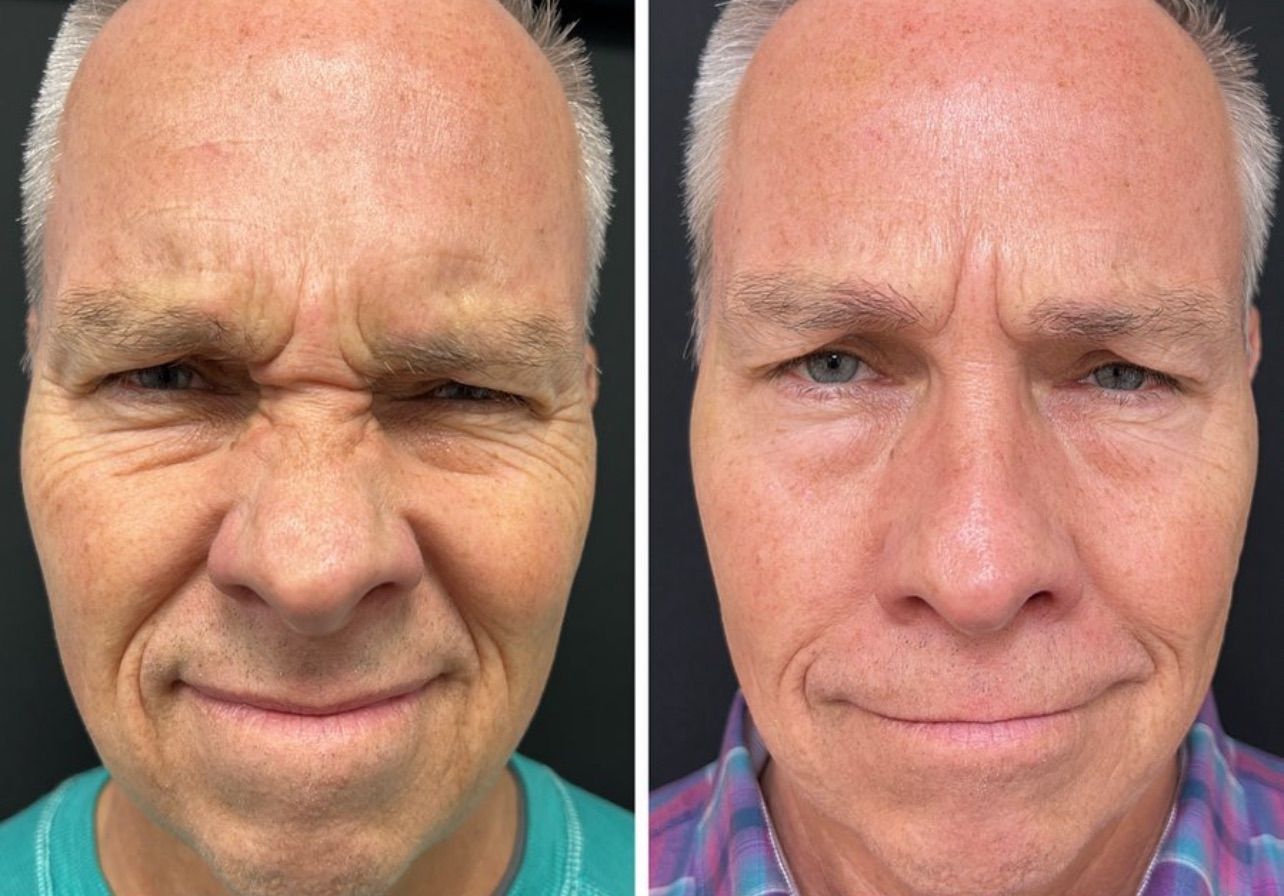 Left side: Man with forehead wrinkles. Right side: Man with smoother forehead after treatment.