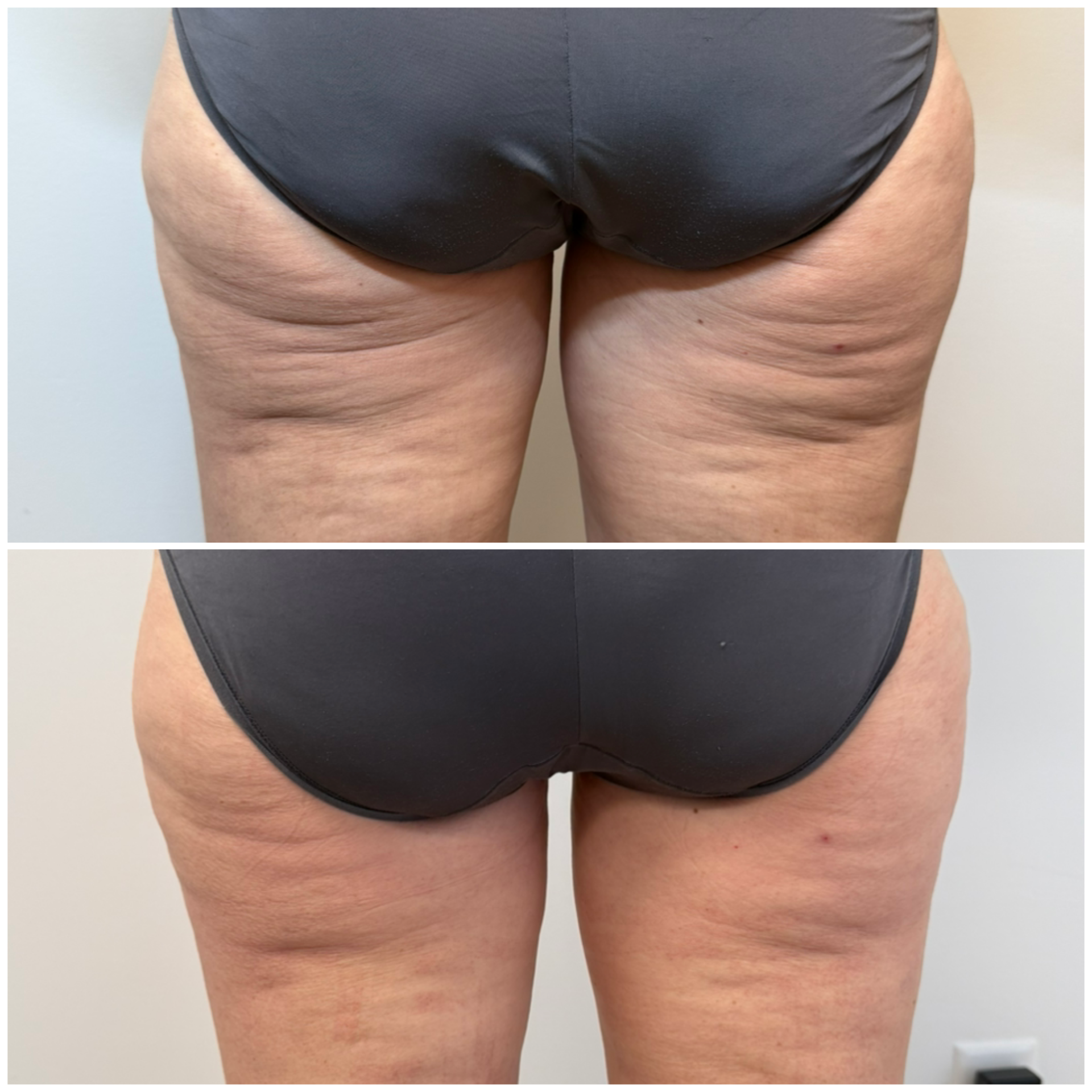 Comparison of upper leg cellulite before and after treatment. Gray underwear, pale skin.