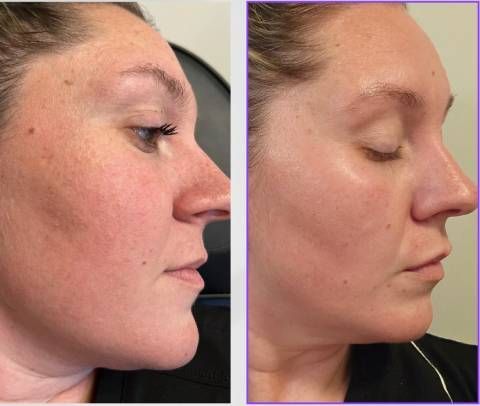 Side-by-side comparison of a person's face. Left side shows more redness. Right side shows reduced redness and improved skin texture.