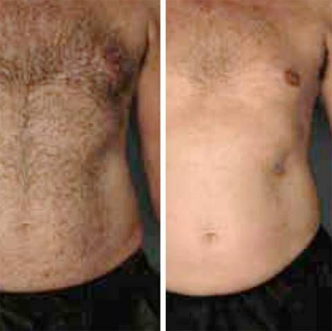 Side-by-side comparison of a torso, before and after hair removal; showing a hair-covered chest and abdomen, then smooth skin.