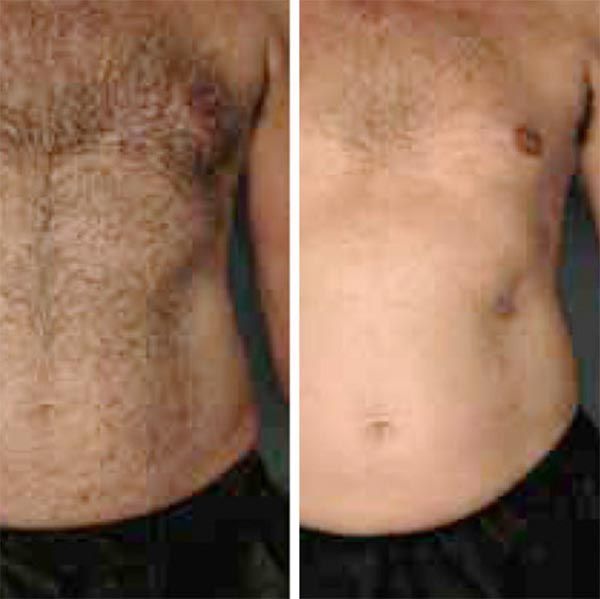 Two images side-by-side show a hairy chest and abdomen compared to a bare chest and abdomen.