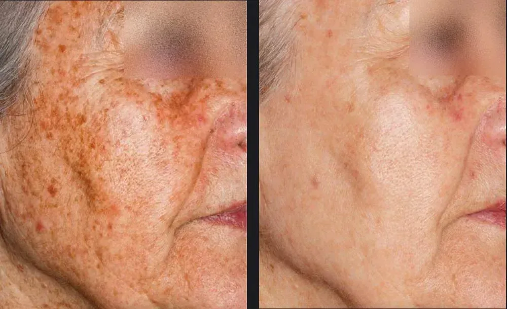 Side-by-side comparison of skin before and after treatment, reducing age spots and discoloration.
