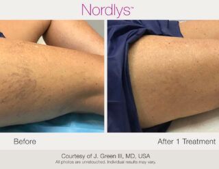 Before and after legs: Nordlys treatment reduces skin discoloration.