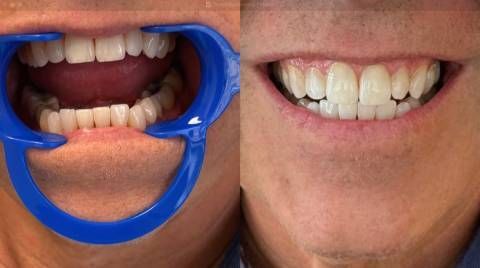 Before-and-after of a person's teeth, showing an opened mouth with a retractor, then a smiling mouth with brighter teeth.