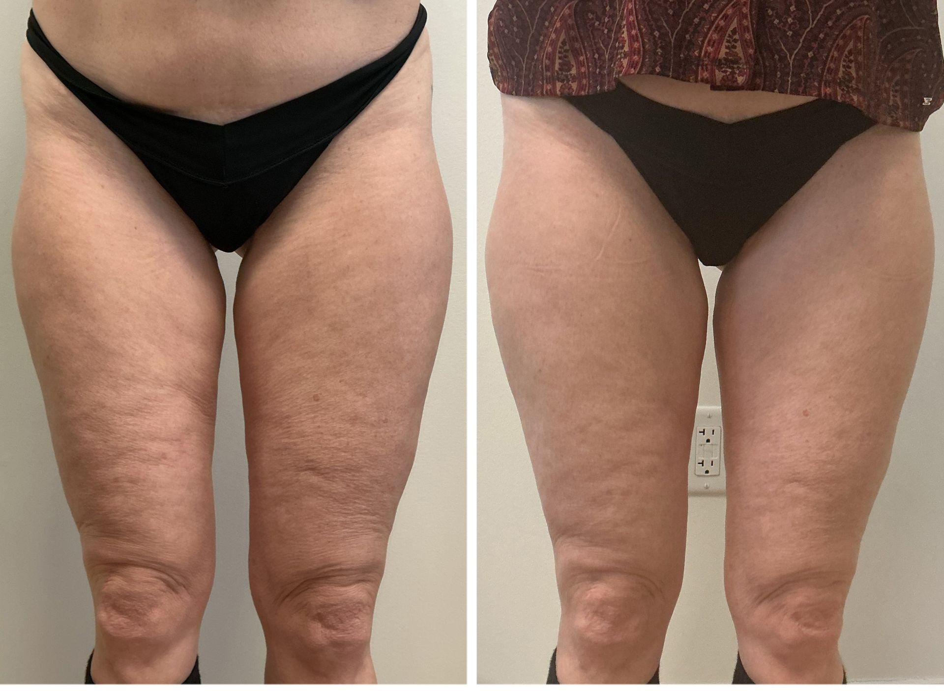 Comparison of two photos of legs. The left shows cellulite, the right shows smoother skin after treatment.