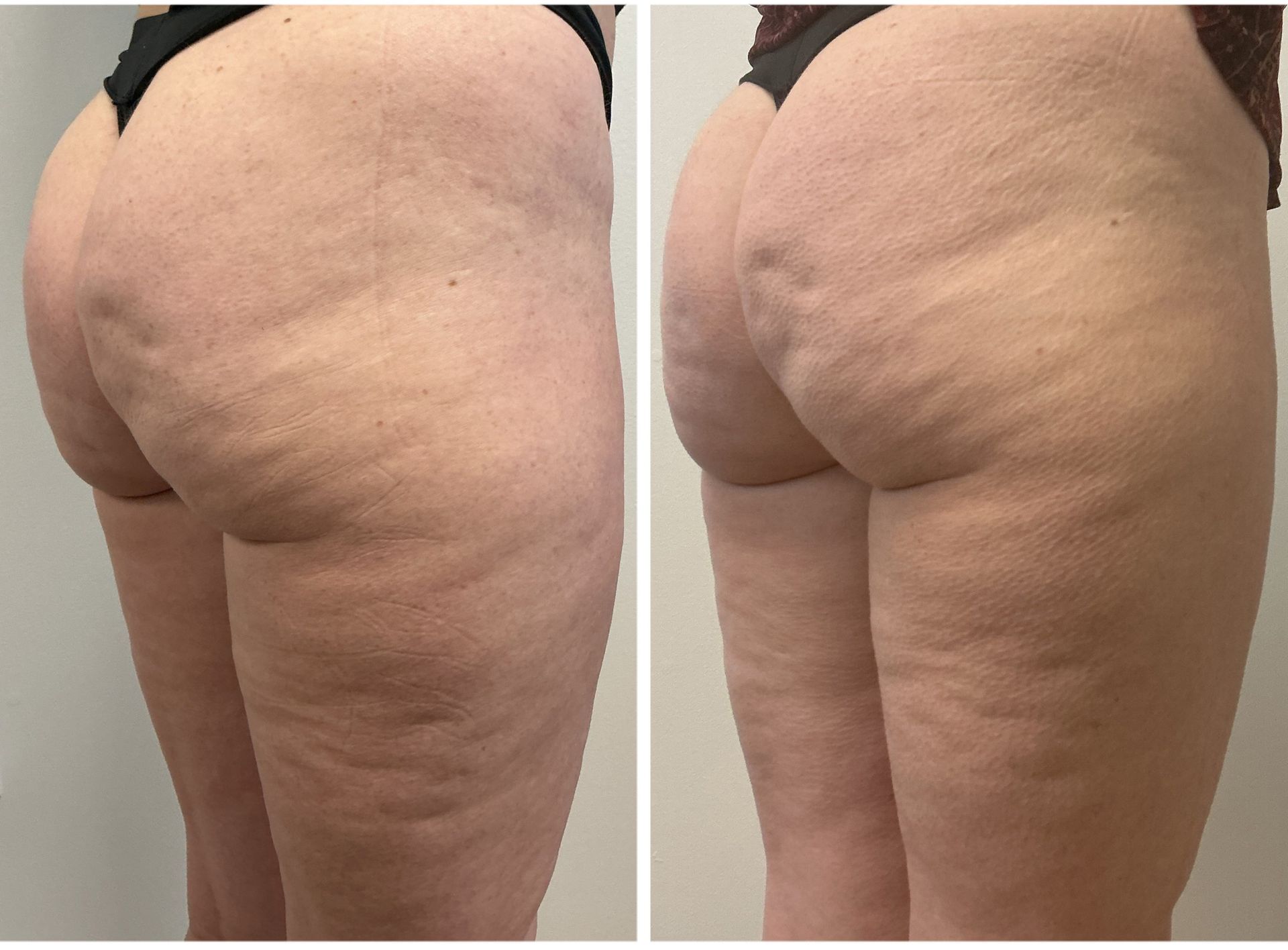 Side-by-side view of a person's buttocks and upper thighs. The left image shows cellulite before treatment, the right image shows a reduced appearance after treatment.