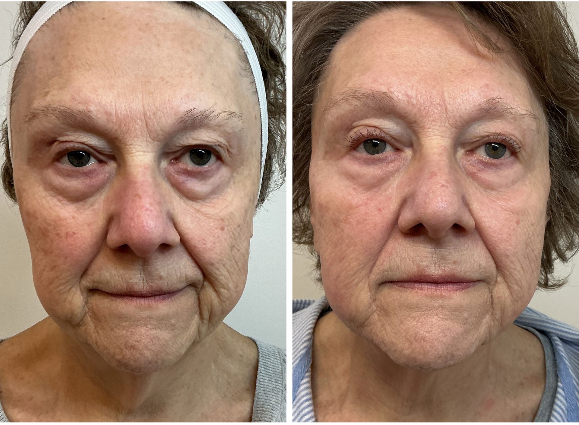 Two side-by-side facial portraits: before and after treatment, reducing wrinkles and improving skin tone.