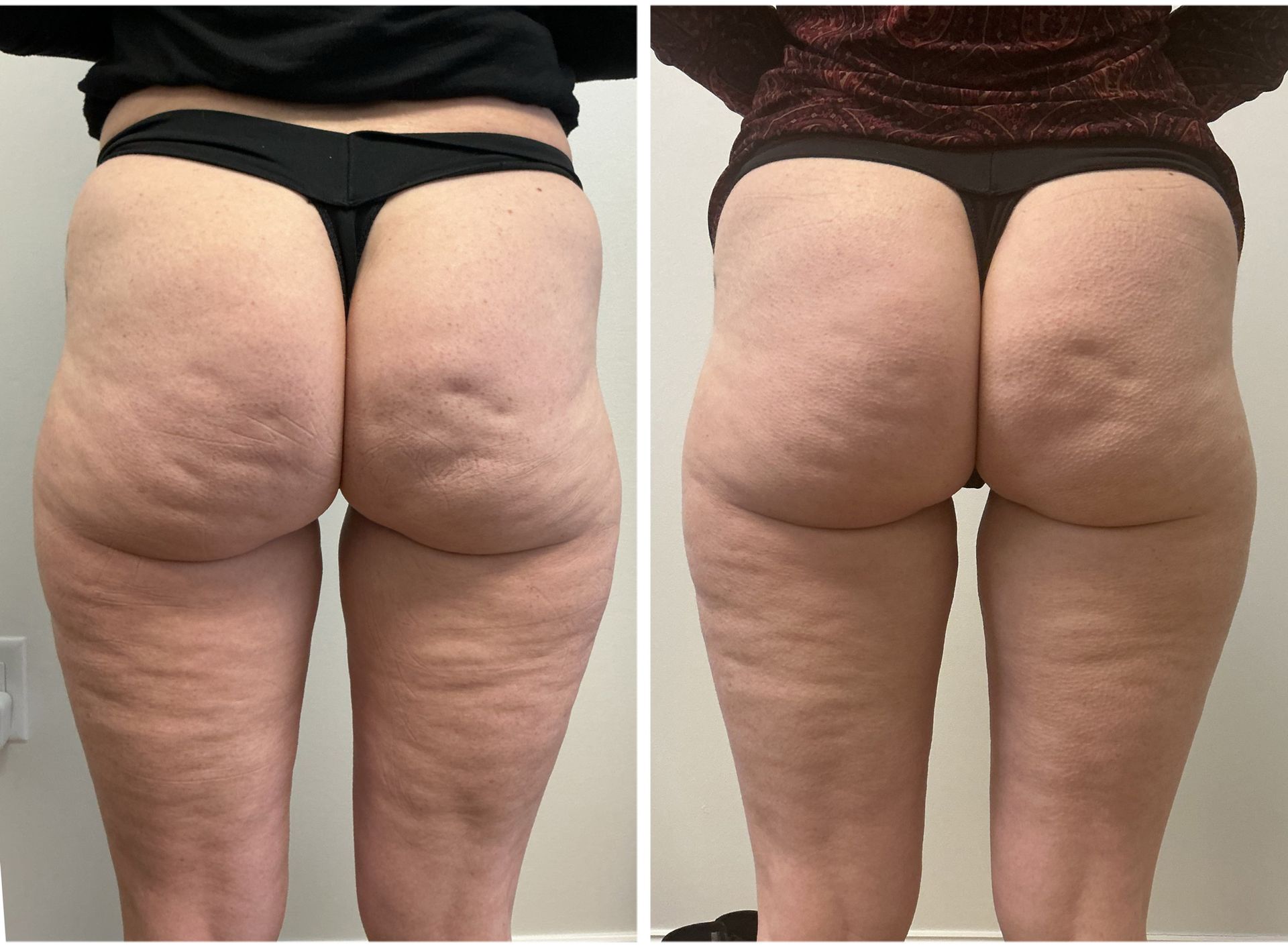 Before-and-after of a person's legs and buttocks; cellulite is reduced after a procedure.