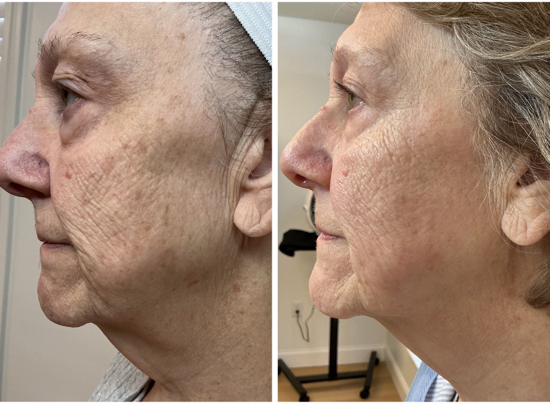 Side-by-side comparison of a woman's face before and after a skin treatment shows reduced wrinkles and improved skin tone.