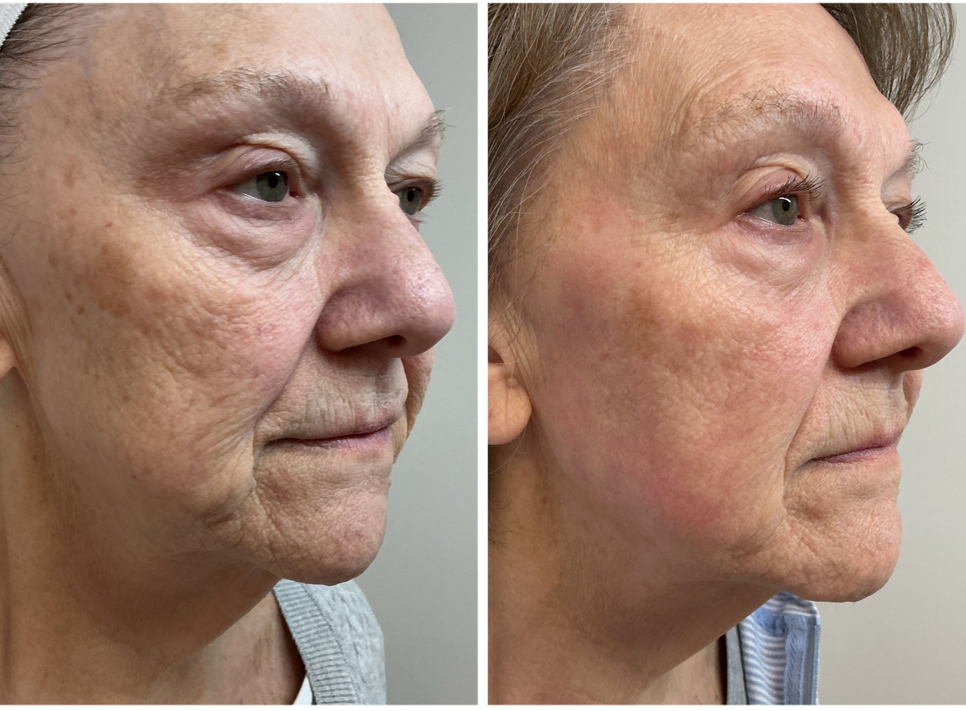 Side-by-side photos of a person's face. Left shows more wrinkles, right shows smoother skin after treatment.