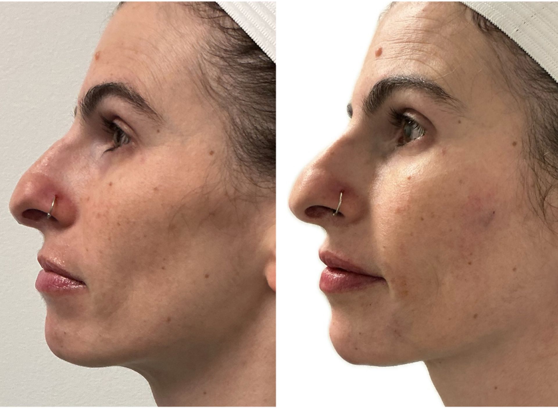 Two side-profile views of a woman's face. The right shows smoother skin and fuller lips than the left.