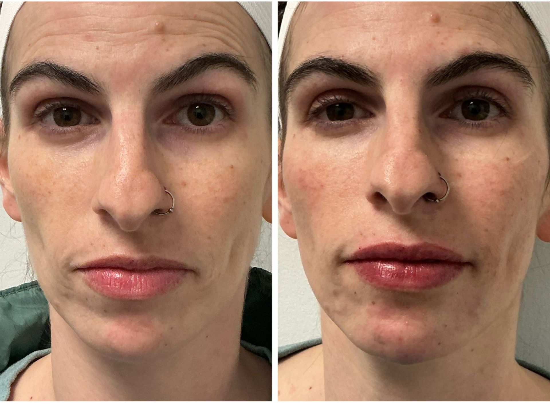 Side-by-side photos of a person's face. Left shows wrinkles, right shows plump lips and less wrinkles.