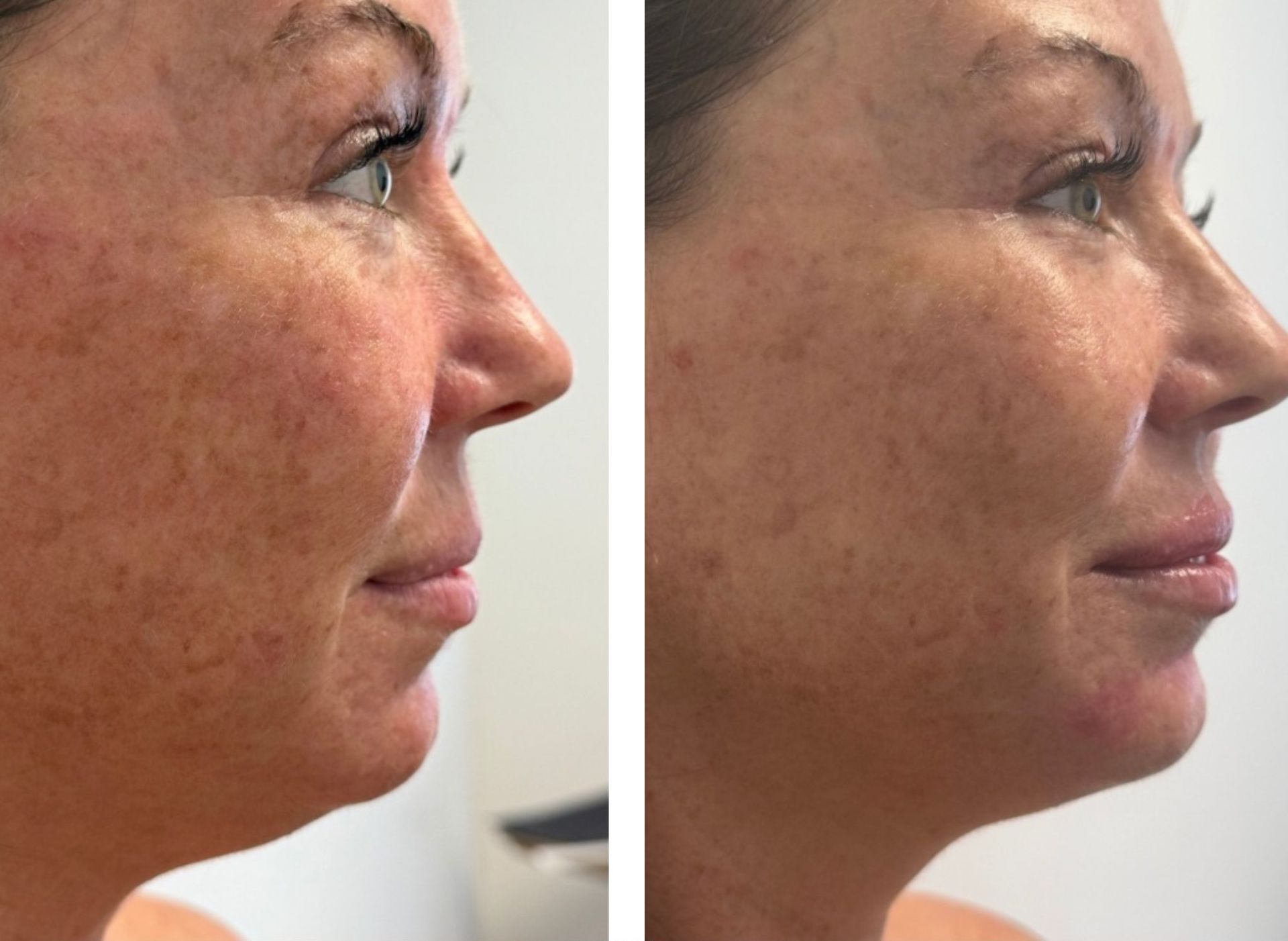 Comparison of a woman's side profile before and after a cosmetic procedure, showing smoother skin and enhanced lips.