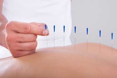Hand placing acupuncture needles into a person’s bare back